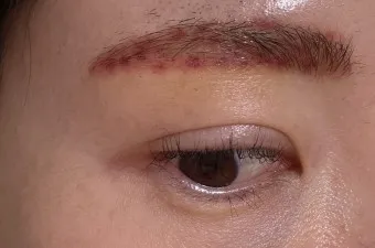 눈썹 문신 제거 방법 꿀팁_21