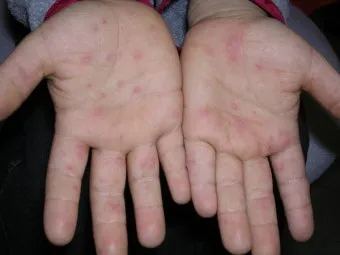 수족구 초기 증상 어른 감염 격리기간 예방 치료 완전 가이드_18