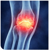 퇴행성 관절염 초기 증상, 그냥 넘기면 치료 시기 놓칩니다