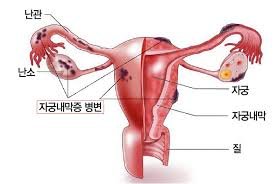 자궁내막증 