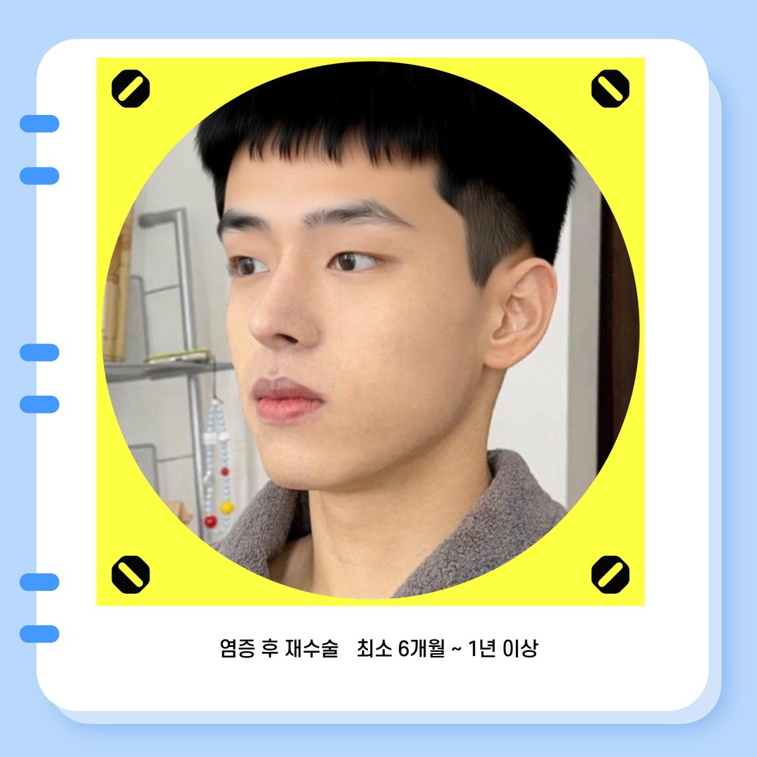 신사역코성형