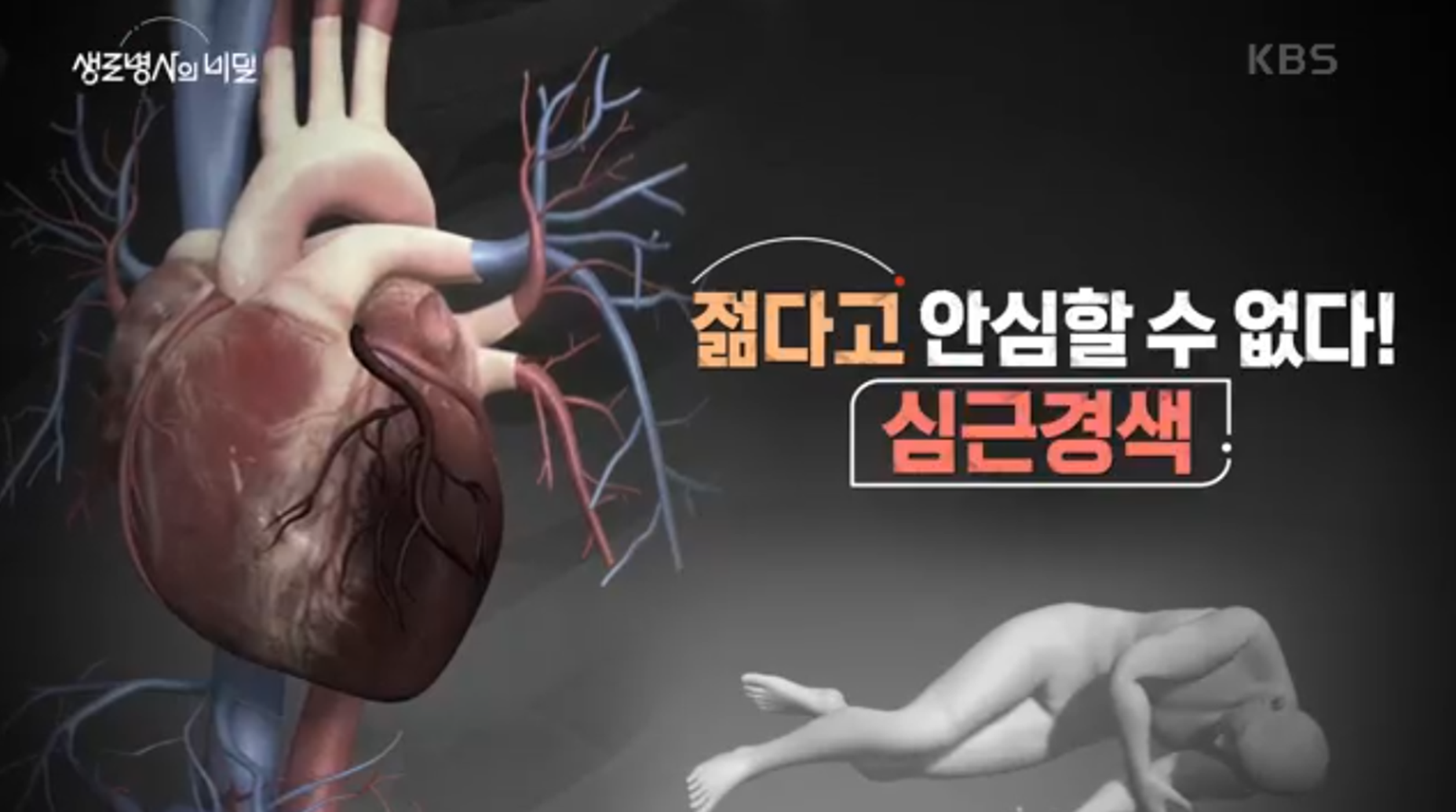 심근경색