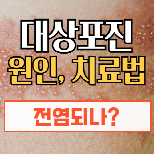 대산포진 원인, 증상, 치료방법