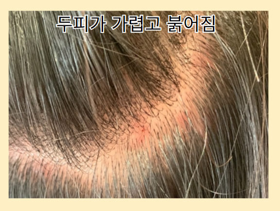 탈모 증상 - 두피 가렵고 붉어짐