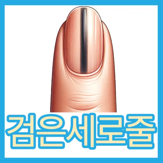 흑색종 손톱에검은세로줄 원인 증상 치료
