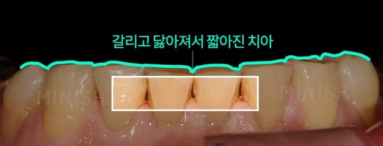 치아 변색
