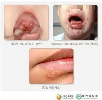 수족구병 증상과 예방 조치 방법 모음_6