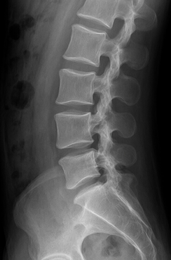 척추관 협착증 운동법