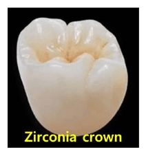 임플란트 보철재 비교 총정리 (Gold PFM Zirconia )