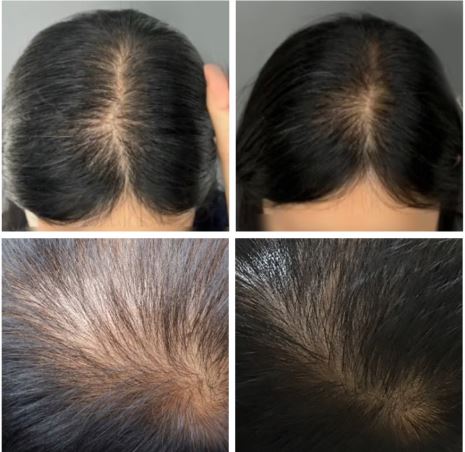 탈모샴푸-판매1위-계림당샴푸