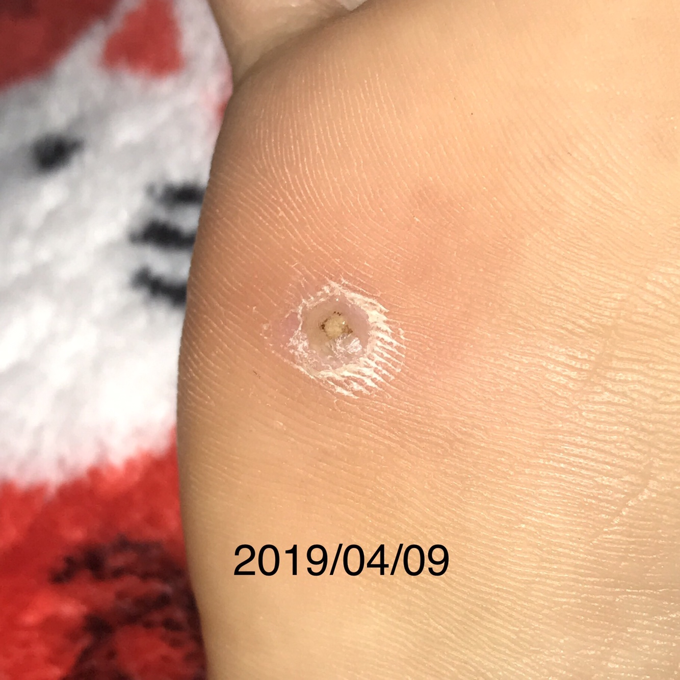 사마귀 치료 사진12