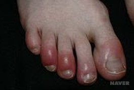 동상 예방법&amp;#44; 동창 응급처치법