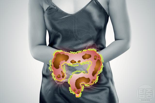 만성변비 합병증 장막힘