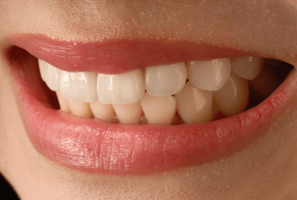 치아의 착색과 차의 연관성, 착색되지 않은 깨끗한 치아