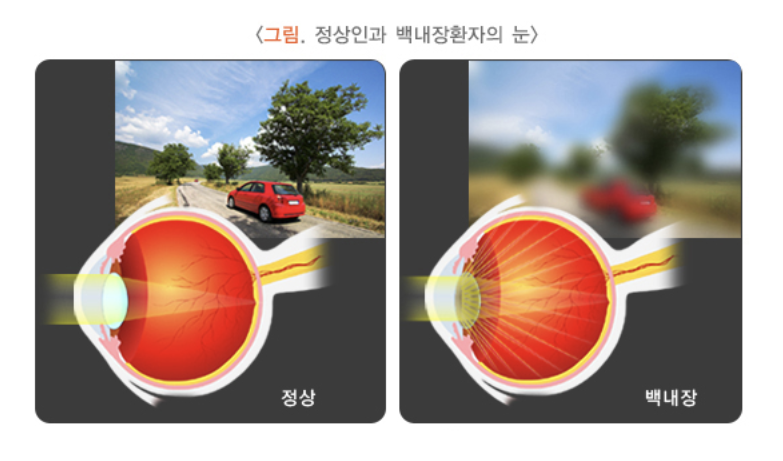 정상인과 백내장 환자의 눈