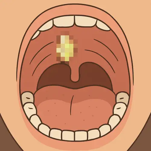 입천장에 가래가 눌러 붙은 모습을 표현한 그림