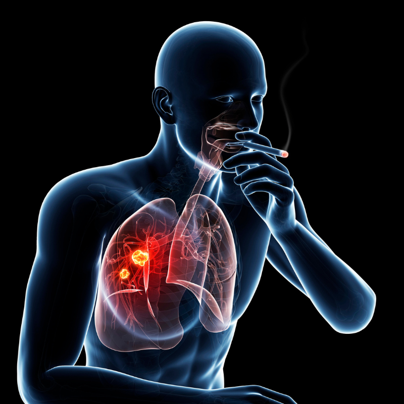 COPD