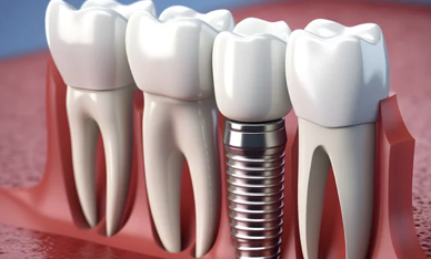 임플란트 모형 사진