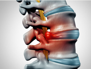 허리 디스크 이미지