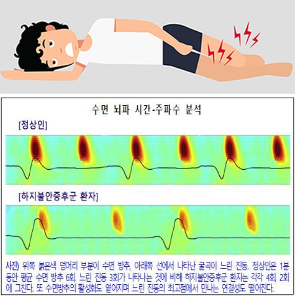하지불안증후군-발생상황-느낌-해소방법-처방약-(+-경험담)