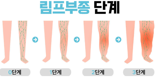 림프부종 관련 이미지