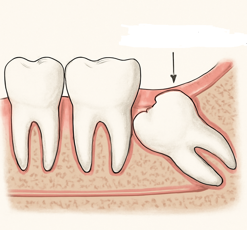 일반적인 사랑니보다 더 깊게 잇몸이나 뼈에 파묻힌 매복사랑니