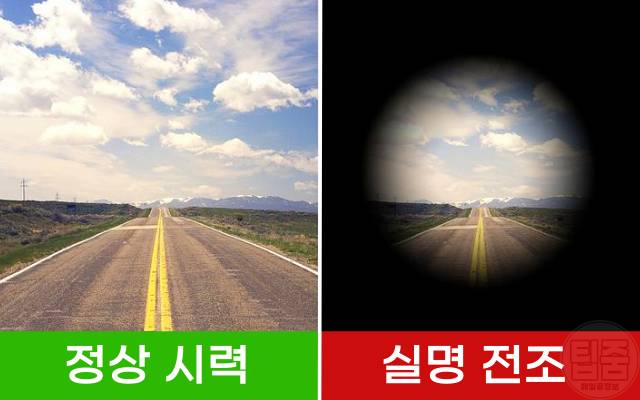 실명 전조증상 당뇨망막병증 황반변성 녹내장 백내장 고도근시 터널비전