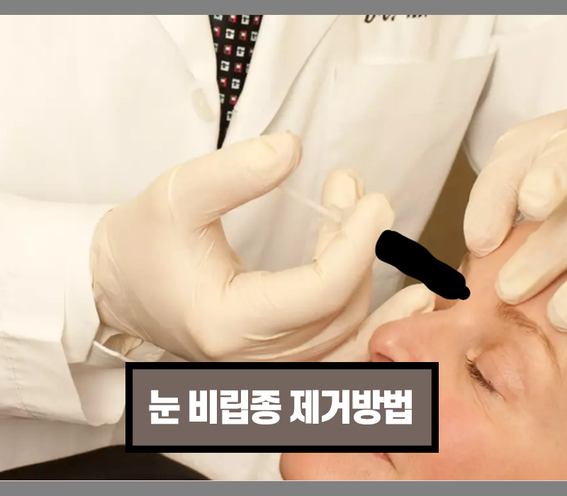 비립종 제거방법으로 레이저치료, 미세침술, 냉동요법, 화학박피 등 전문적인 시술이 안전하고 효과적입니다.