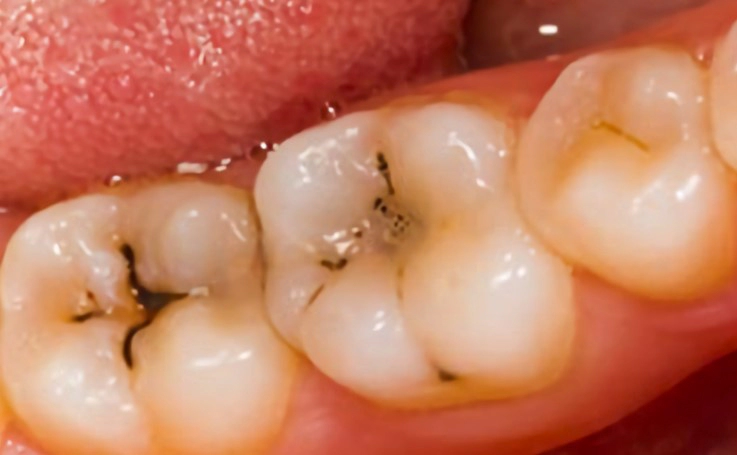 치아 우식증 예방법 10가지