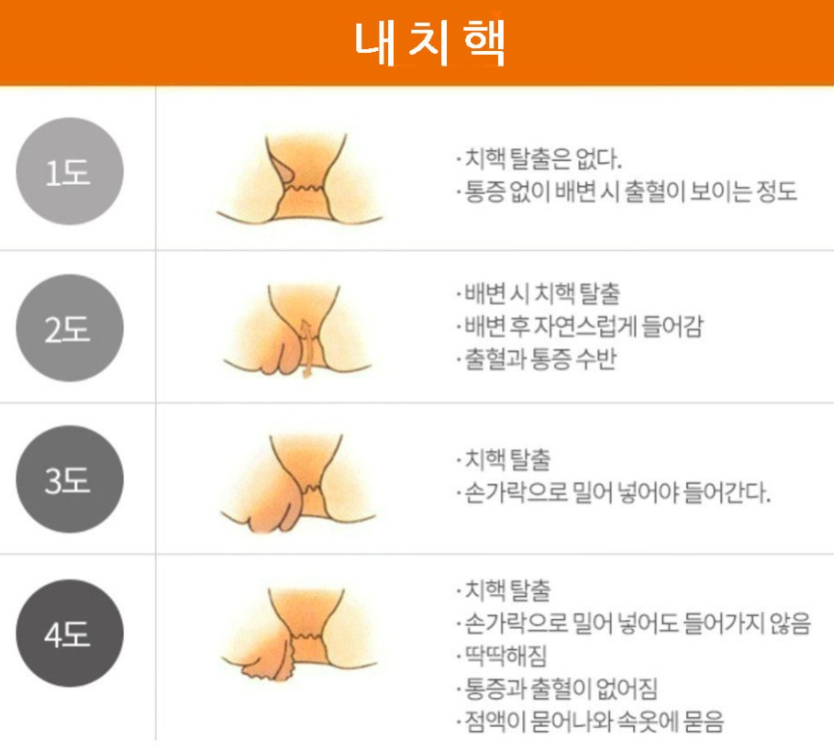 치질 증상 구체적인 사진
