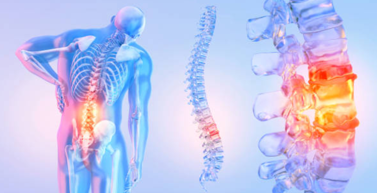 경추 추간판 탈출증과 관련된 사진