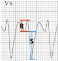 R/S < 1
no R wave