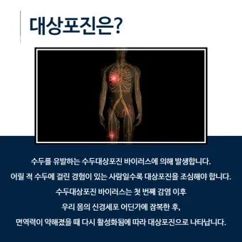 대상포진 치료방법에 대한 총정리 건강 질병관리_24
