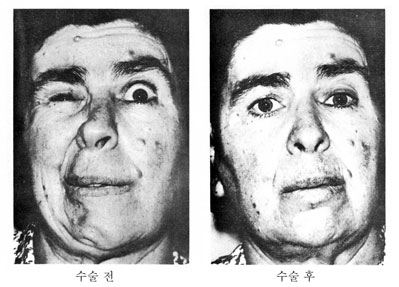 얼굴의 떨림과 불편함: 반측성 안면 경련에 대한 이해와 치료