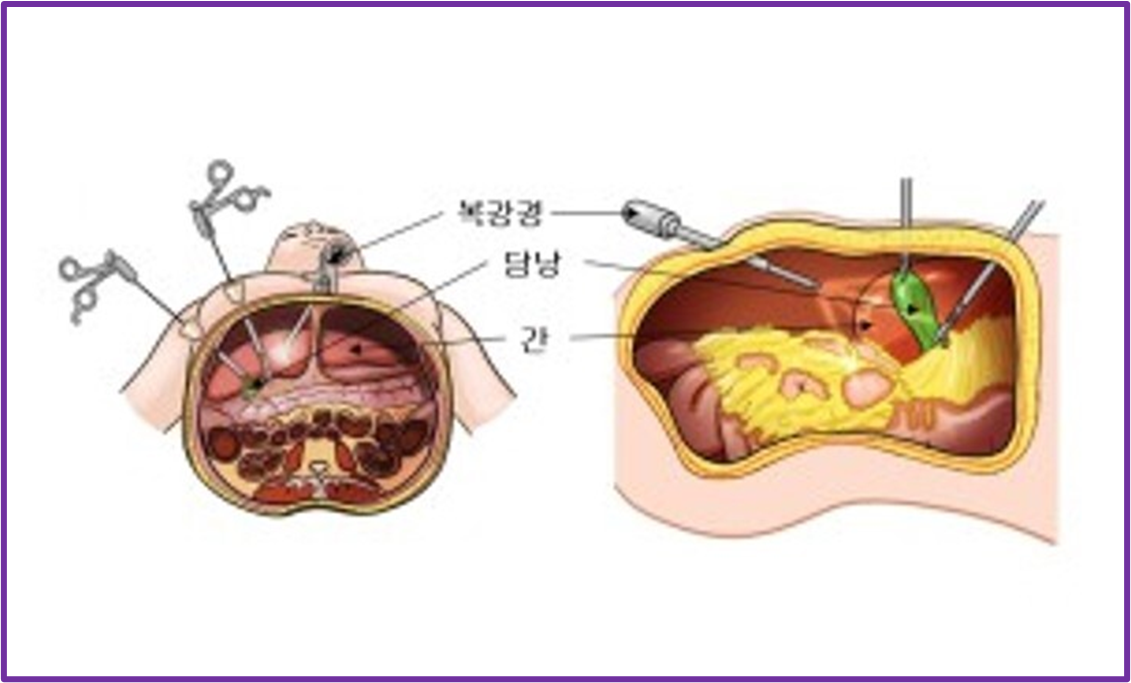 복강경 수술