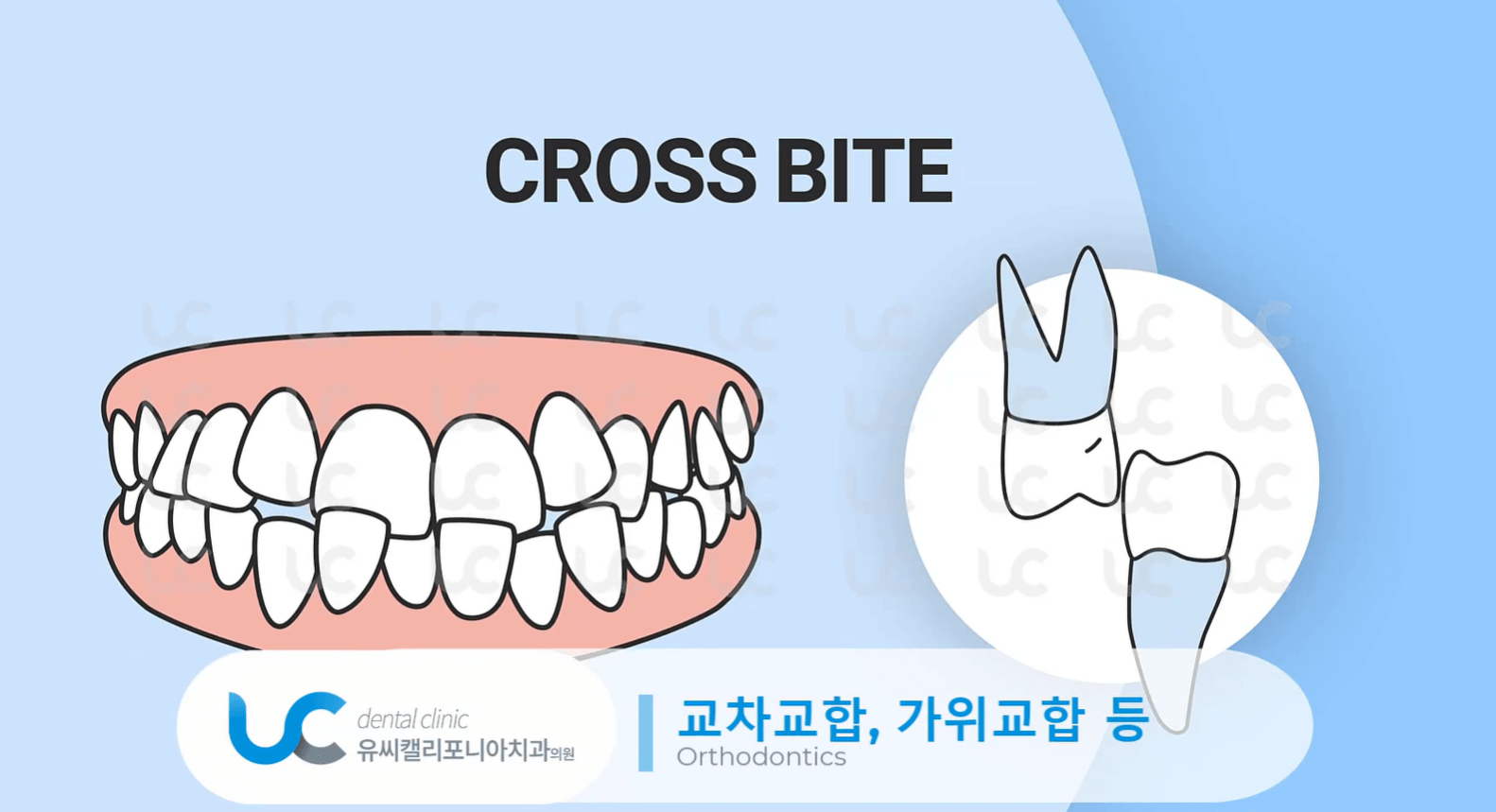 과개교합-치료-안하면