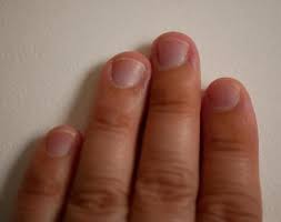 손톱에 세로줄이 생기는 이유