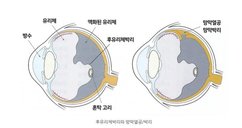 망막박리 및 망막열공을 그림으로 설명