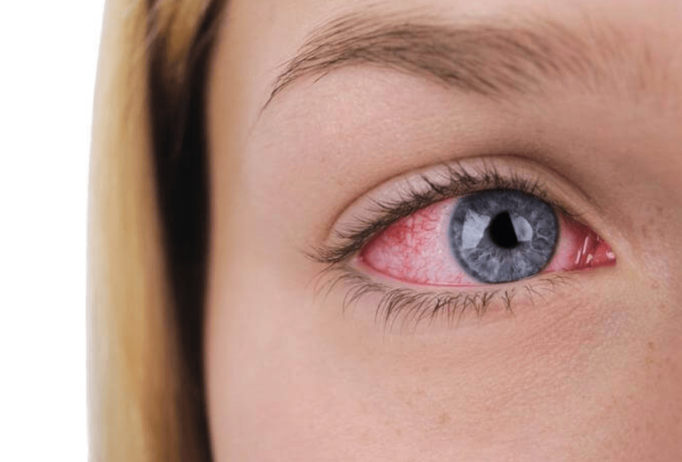 충혈된 눈