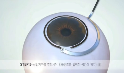 아이링-시술-후기-내돈내산