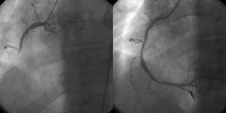 Percutaneous coronary intervention 경피적관상동맥중재술