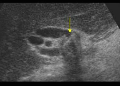 Mirizzi&amp;#39;s syndrom