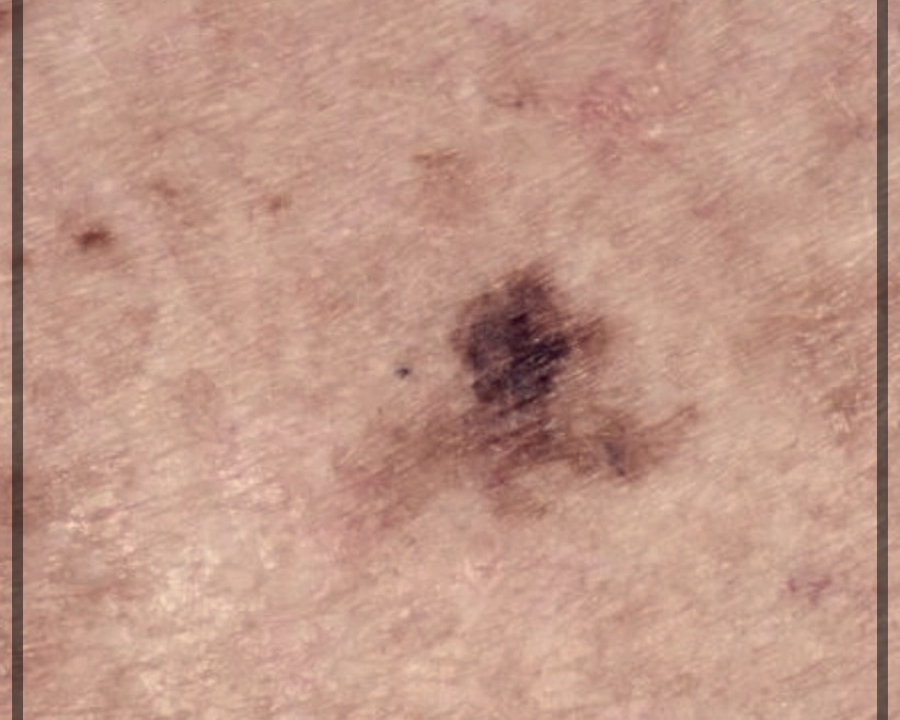 후천성 오타모반 이란?기미. 주금깨 주범.