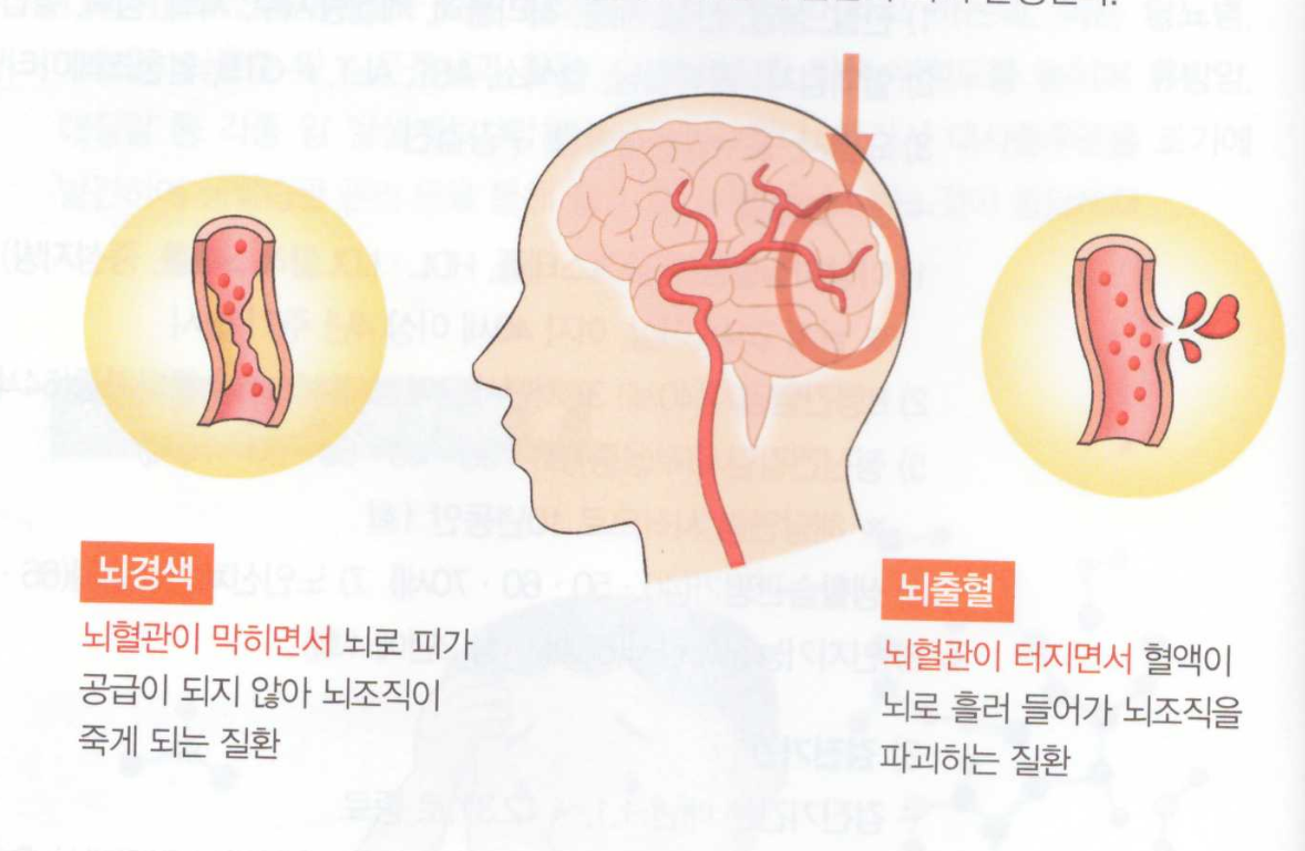 뇌경색 뇌출혈-차이점