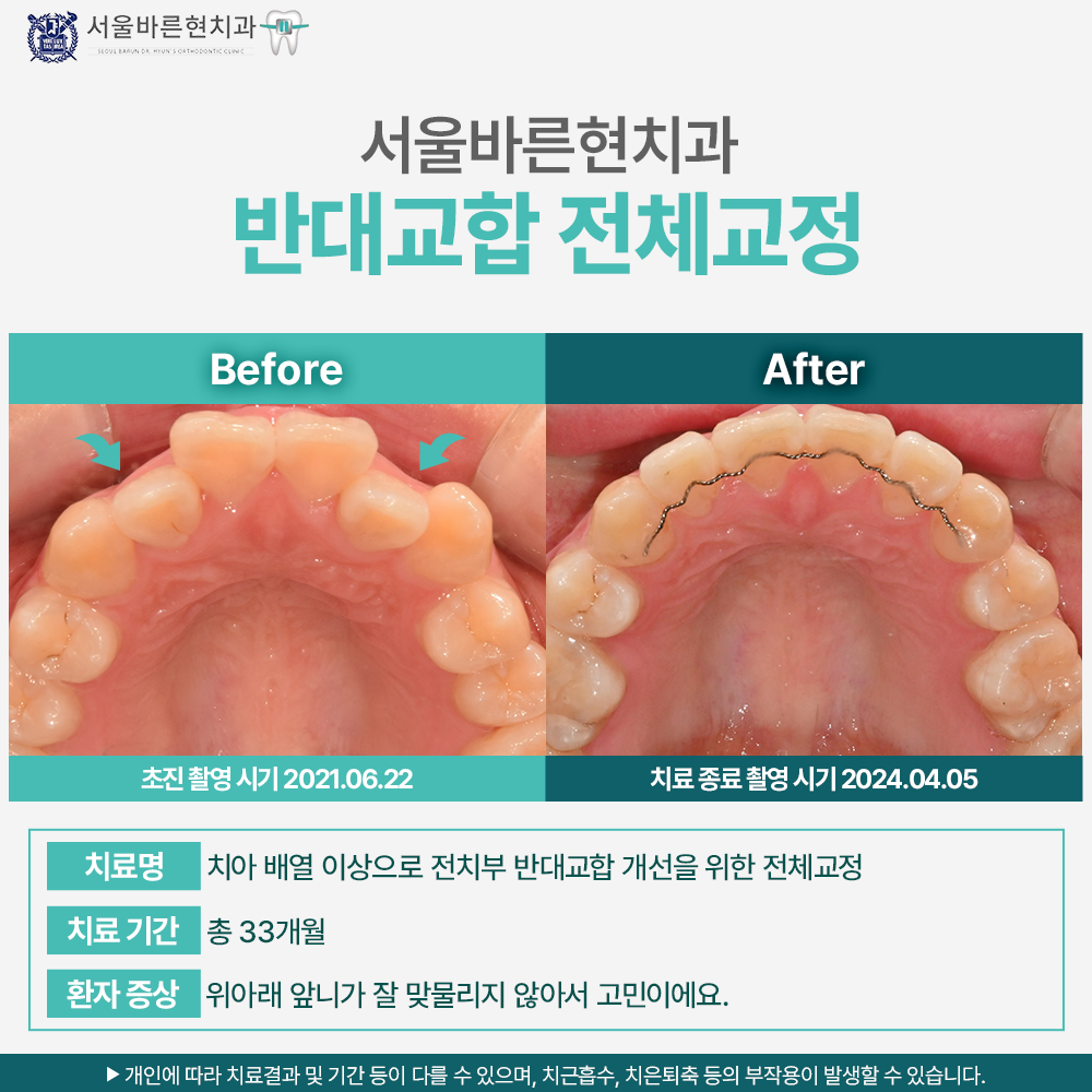 해운대치과전체교정추천