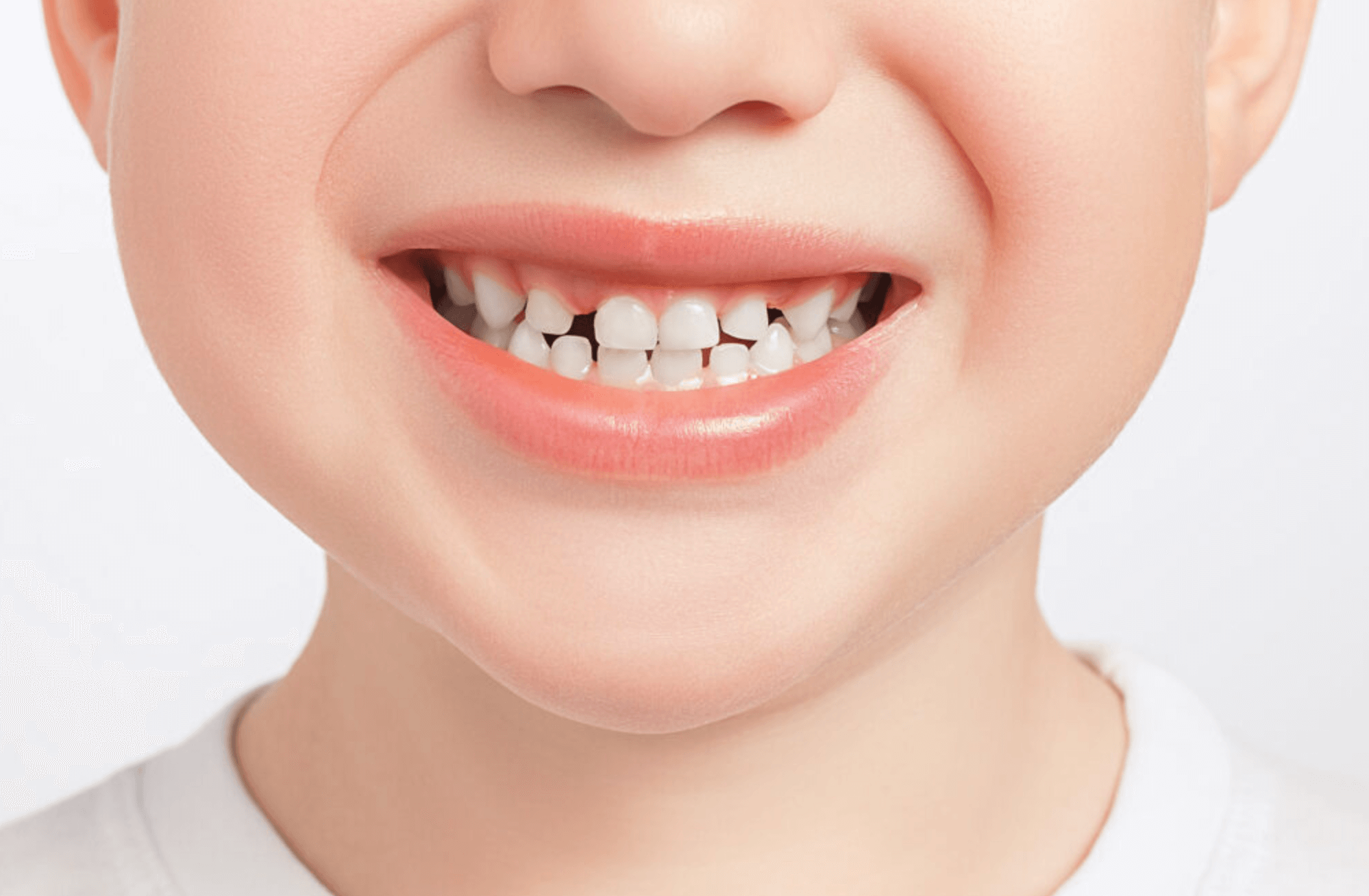 벌어진 앞니 후기