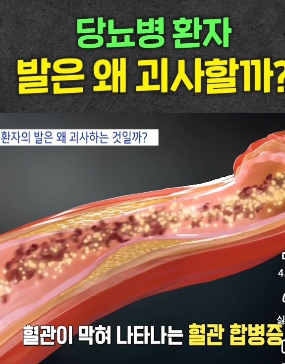 명의-당뇨발-천동일-교수-족부-정형외과