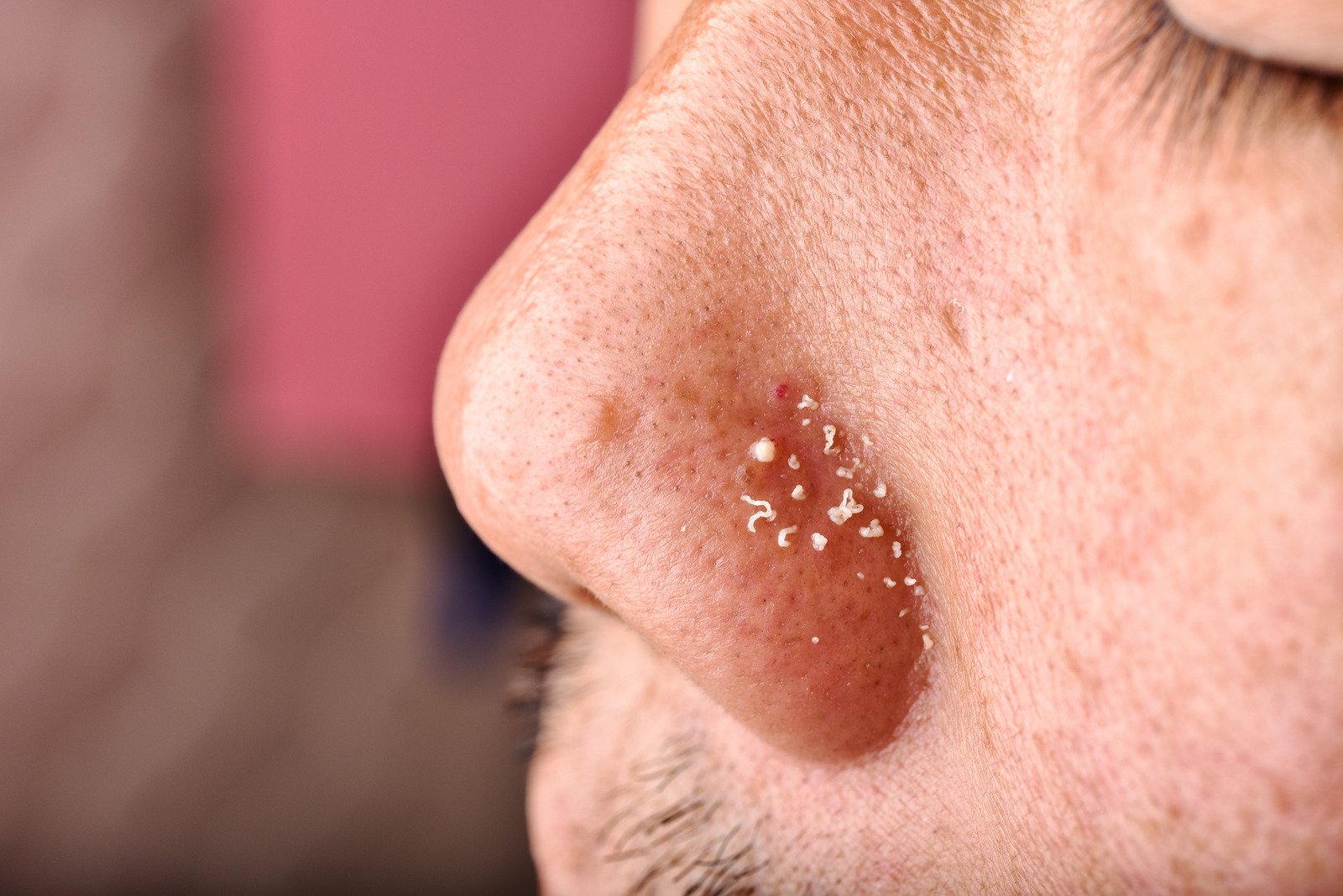 좁쌀여드름: 원인, 예방법, 그리고 치료법