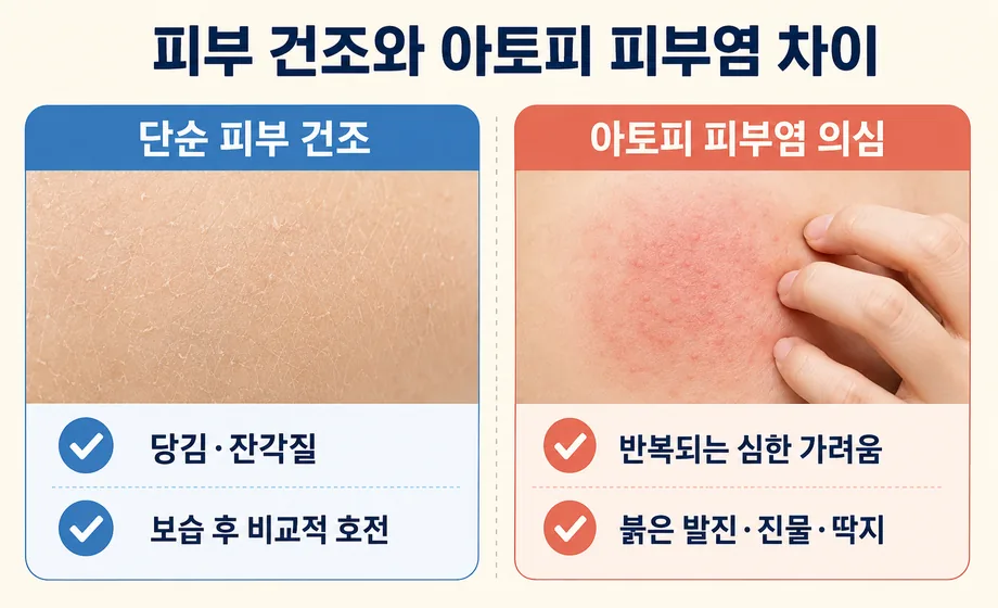단순 피부 건조와 아토피 피부염 의심 증상 차이 비교