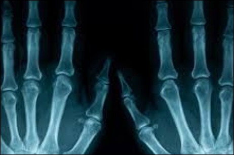 손가락 마디 통증 11